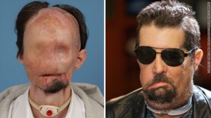 Face Transplant Before and After